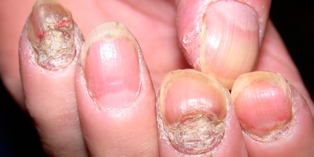 Nail Disorders